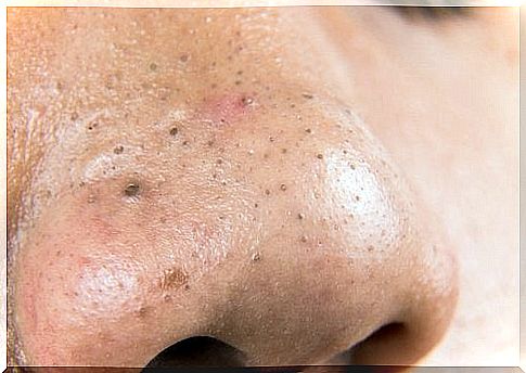 5 natural remedies against blackheads