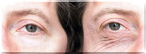 Women who need natural remedies for droopy eyelids