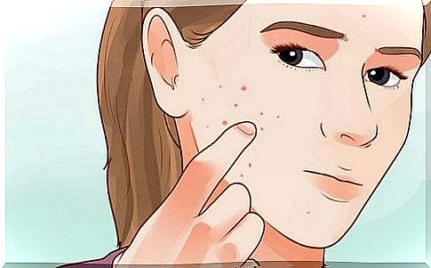 Acne caused by hormonal imbalances that affect physical appearance