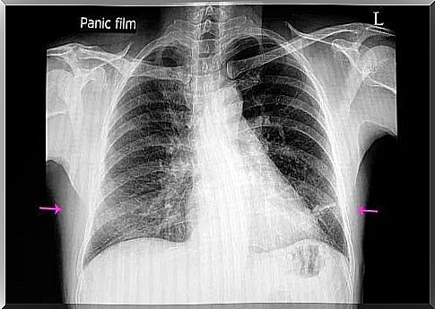 Causes and symptoms of atelectasis