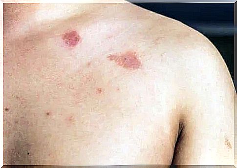 Description and characteristics of pityriasis versicolor