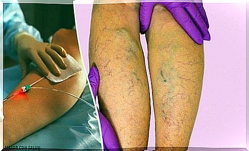 Find out what varicose veins are and how they are treated