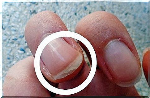 Remedies for fragile nails