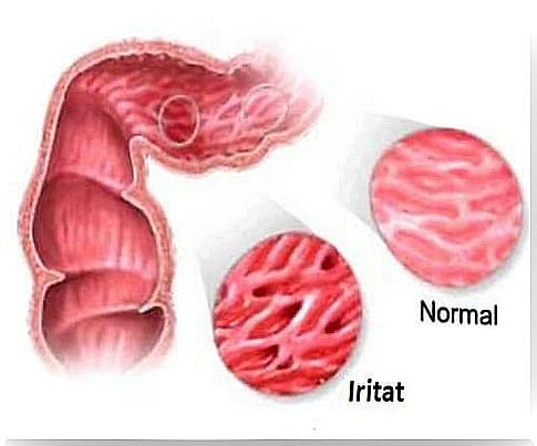 Irritable bowel syndrome - 4 tricks to treat it