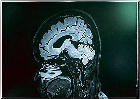 Naegleria Fowleri infection seen on MRI