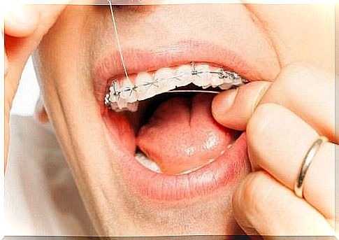 Oral hygiene with dental braces