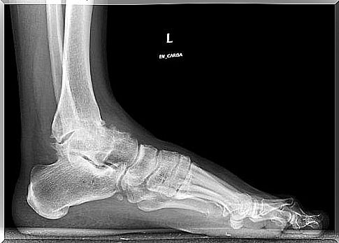 Osteoarthritis of the ankle should be treated appropriately