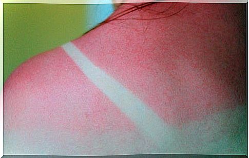 The best remedies for sunburn