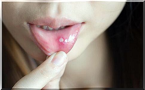 Treatment for ulcers and canker sores