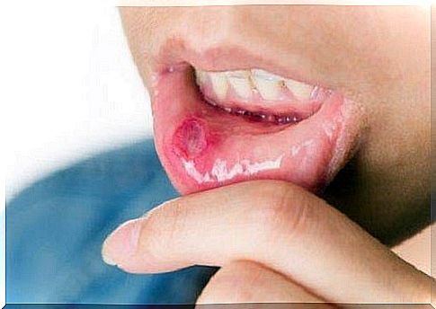 Mouth ulcers