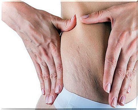 Areas with stretch marks