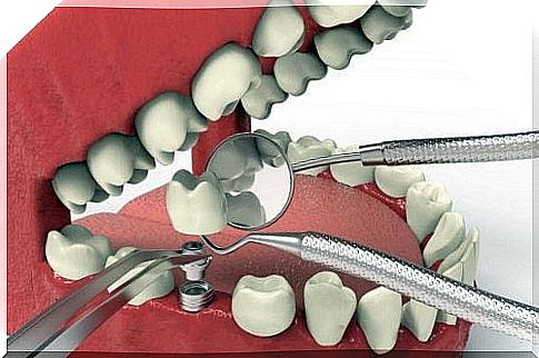 Implant dental treatments