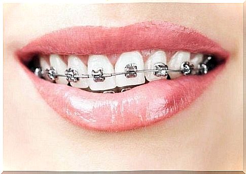 Teeth with braces