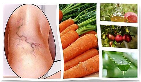 Varicose vein remedy with 3 ingredients