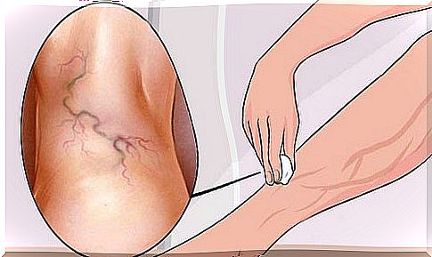 Remedy for varicose veins applied to the affected areas of the feet