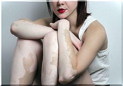 Vitiligo can be caused by the patient's genetic inheritance