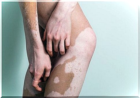 Vitiligo can be classified into 2 types