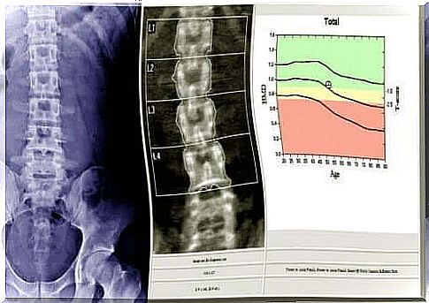 What is bone densiometry?