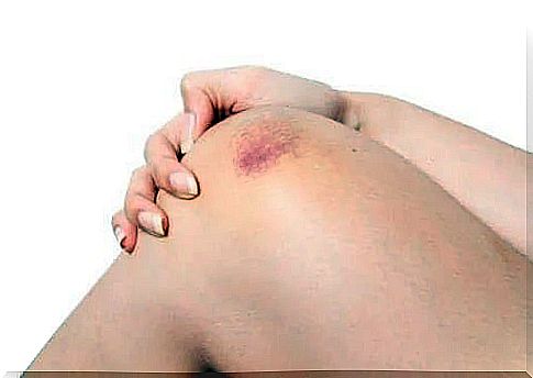 What is bruising and why does it occur?