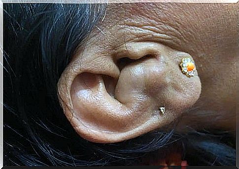 Cauliflower ear in women