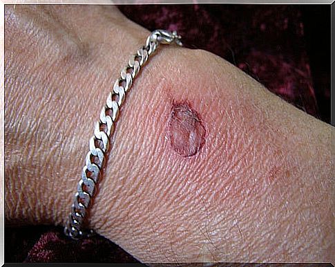 A very severe burn can cause blisters